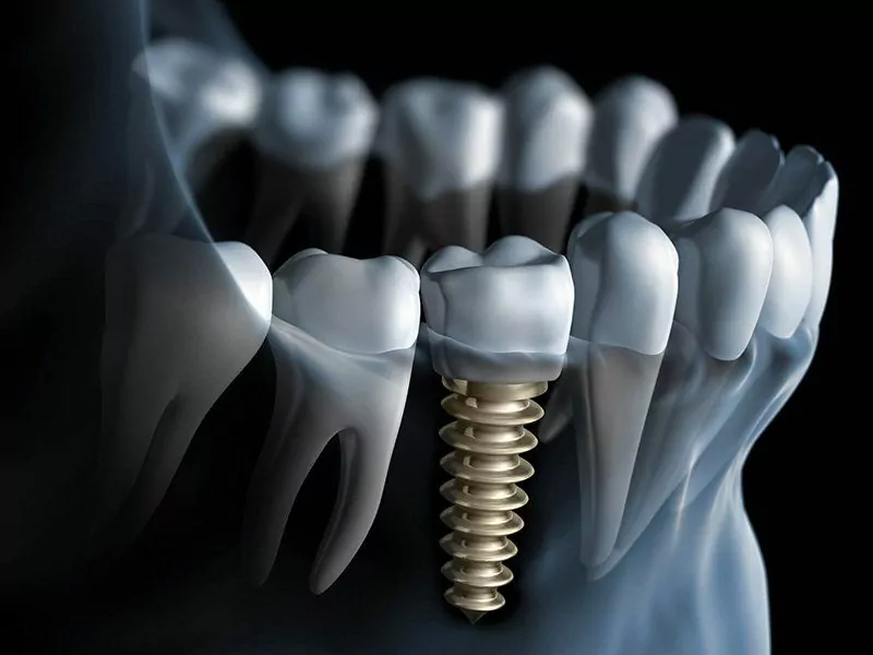 Clínica especialista en implantes dentales en Galapagar